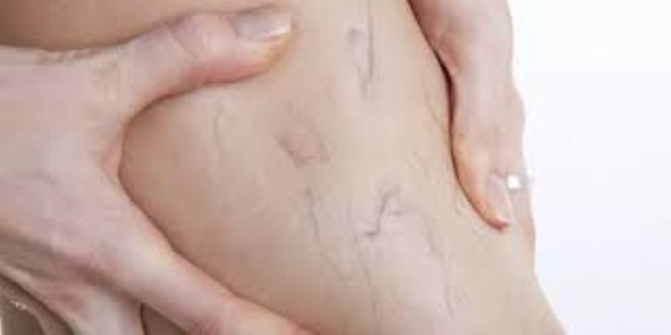 3 خطوات لحماية صحة الساقين من الأصابه بالدوالي 3 خطوات لحماية صحة الساقين من الأصابه بالدوالي
