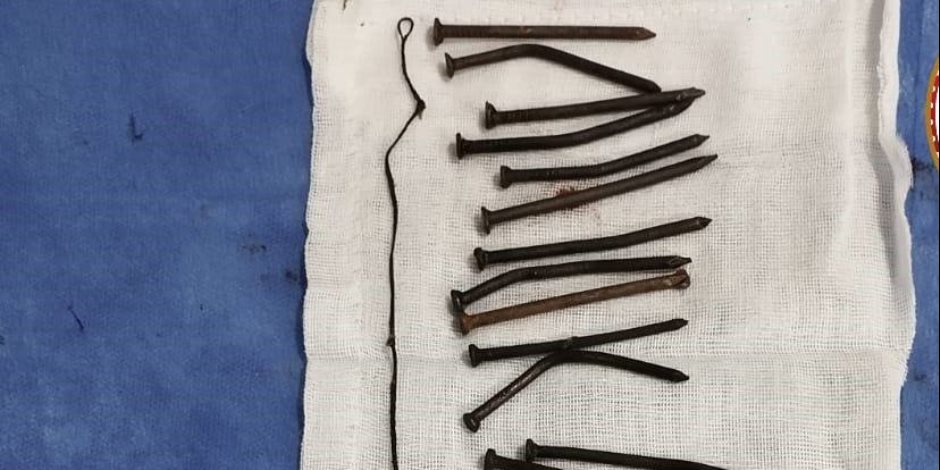 تفاصيل إنقاذ سيدة ابتلعت 34 مسمارًا منذ 45 يوما في كفر الشيخ