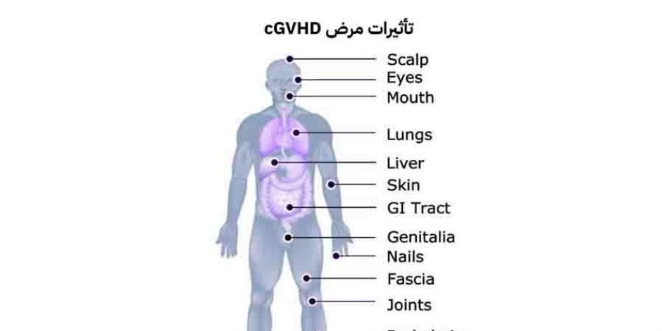 مرض الطرد العكسي المزمن.. التحدي الصامت بعد زراعة الخلايا الجذعية في مصر
