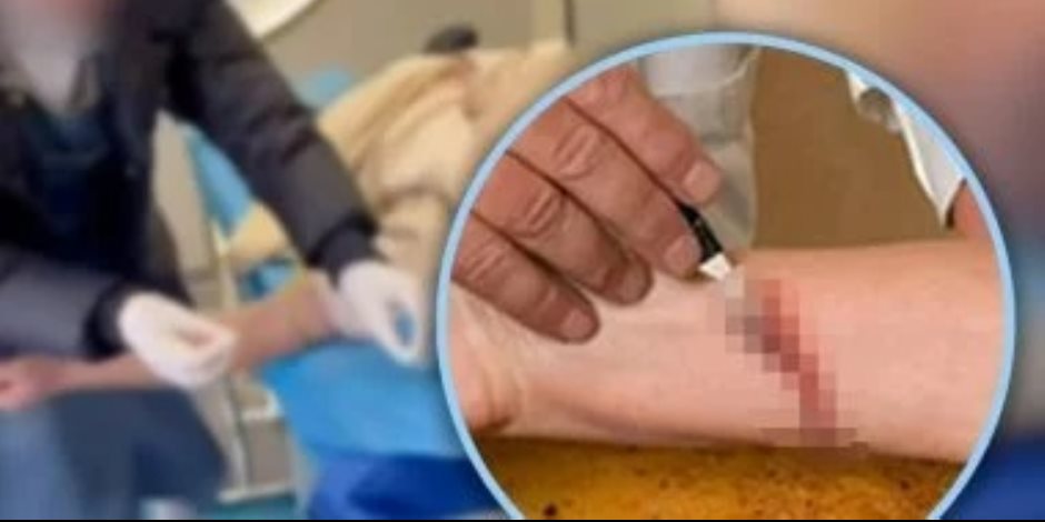 حدث في الصين .. القبض على أطباء يدعون العلاج بالفصد «الإدماء» لإزالة الطاقة الشريرة