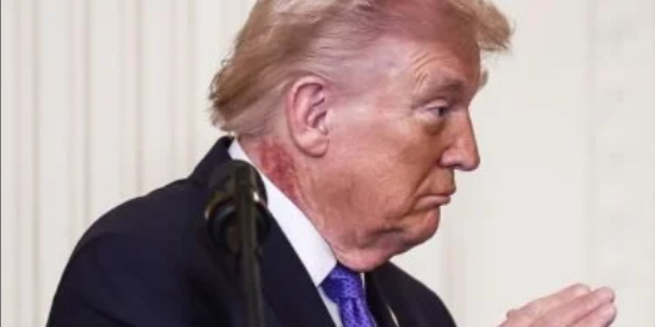 طفح جلدي برقبة ترامب يثير تساؤلات.. وأطباء يرجّحون إصابته بالتقرن السفعي