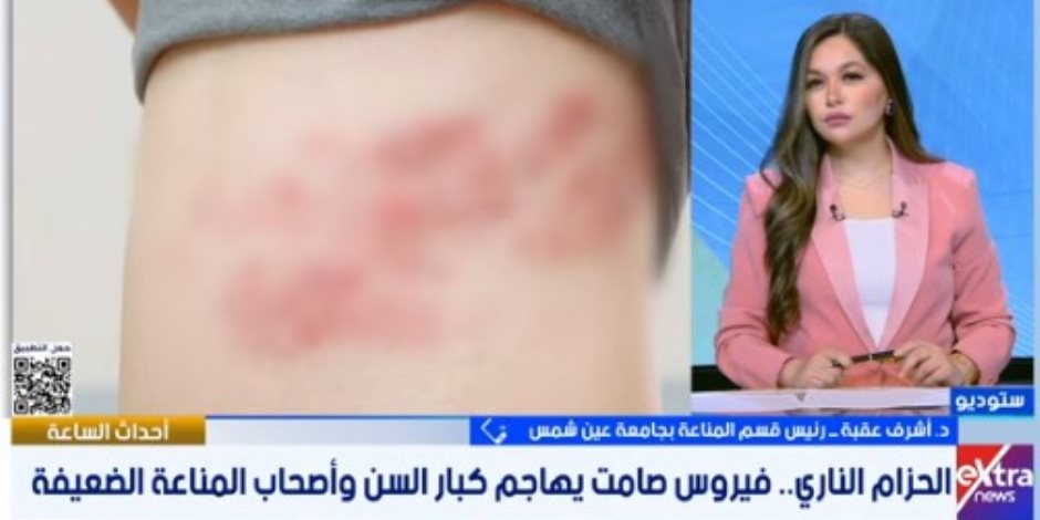احذر الحزام الناري.. طبيب يوضح الأعراض والفئات الأكثر عرضة