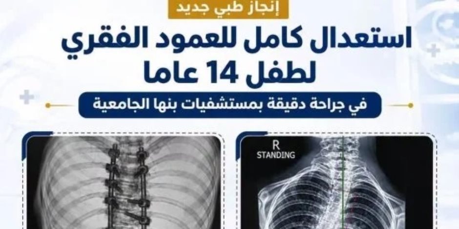إنجاز طبى بمستشفيات جامعة بنها  .. استعدال كامل للعمود الفقرى لطفل 14 عامًا 
