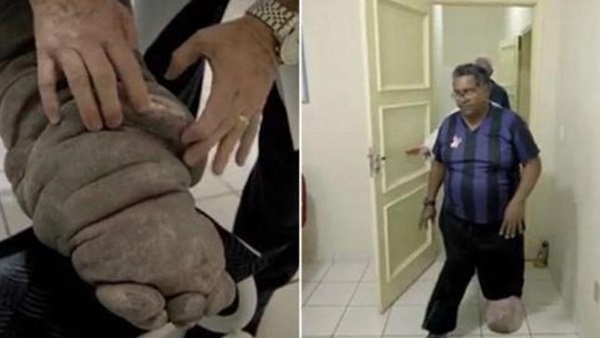  برازيلي مصاب بمرض نادر يحوله إلى "فيل"