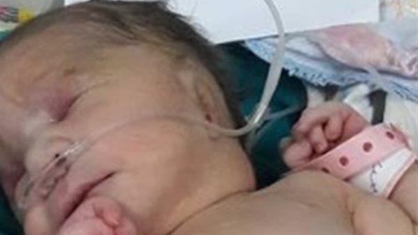 ولادة طفل بأمعاء خارجية وأذن واحدة في أسيوط ولادة طفل بأمعاء خارجية وأذن واحدة في أسيوط