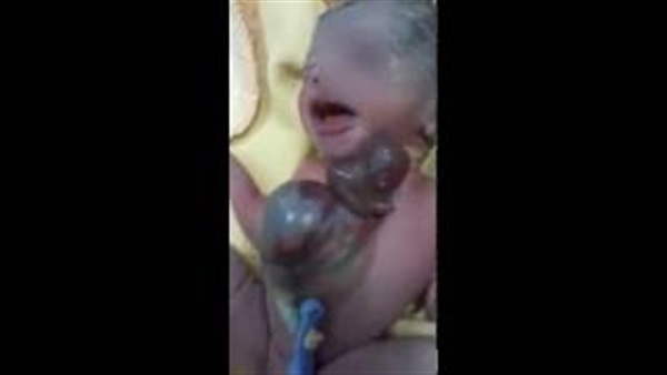 بالفيديو.. ولادة طفل قلبه خارج جسده بمستشفى أبو الريش