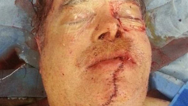 بالصورة.. عجوزأسترالي يقص وجهه بالمنشار الكهربائي