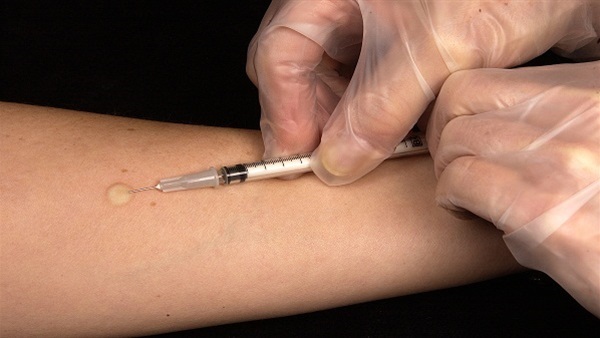 اختبارات سل سريعة جديدة يمكن أن تقلل الوفيات