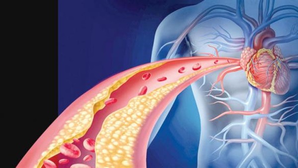 تحذير من مرض فرط كولسترول الدم الوراثى والذى يؤدى إلى الوفاة المبكرة
