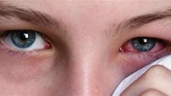 تعرف على أبسط علاج فعال لالتهابات العيون