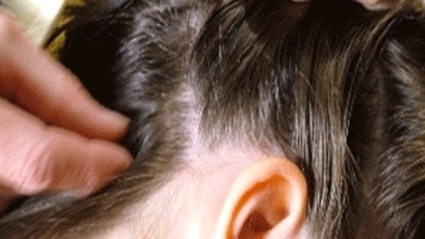 علماء يحذرون من خطورة «القمل» على فروة الرأس