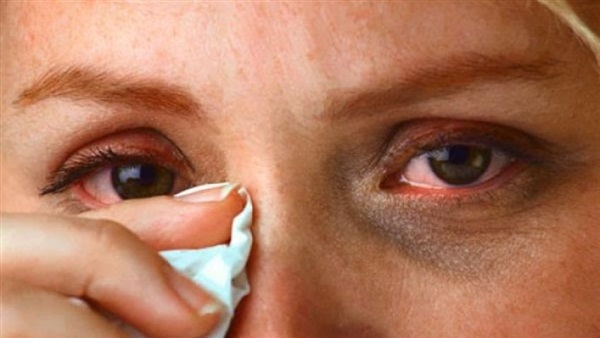 إنفلونزا العيون مرض جديد يواجة البشرية 