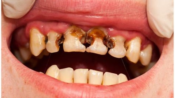 جوز الهند  تُخلصكم من تسوس الأسنان 