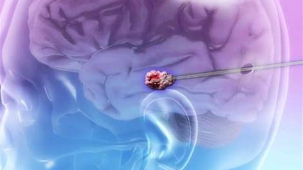 اكتشاف طريقة جديدة لعلاج سرطان المخ اكتشاف طريقة جديدة لعلاج سرطان المخ