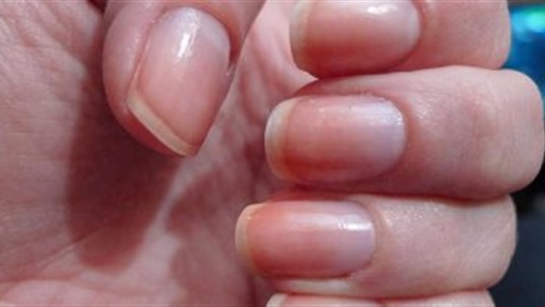 أظافرك مرآة لصحتك.. اعرف حالتك الصحية من لونها وصلابتها