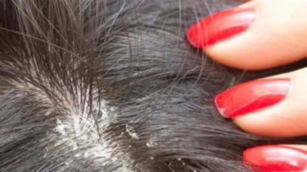 4 وصفات طبيعية تخلصك من قشرة الشعر.. تعرفى عليها