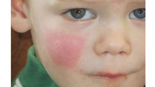 الحساسية ترفع احتمالات إصابة الأطفال بالاكتئاب