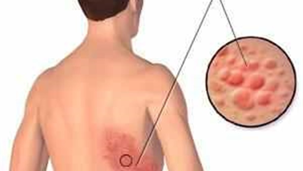 دراسة: الهربس النطاقي يزيد احتمال الإصابة بأمراض القلب