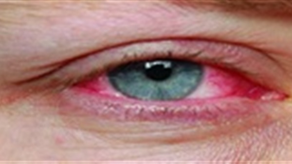 «إنفلونزا العيون».. فيروس شديد العدوى ليس له علاج