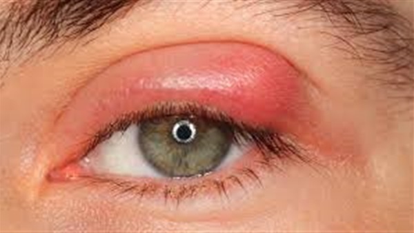 6 علاجات منزلية لخراجات العين