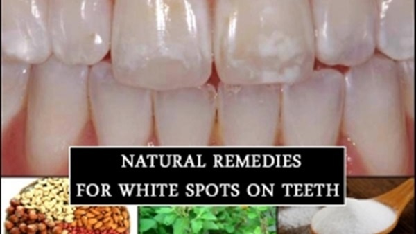 6 طرق للتخلص من بقع الأسنان البيضاء