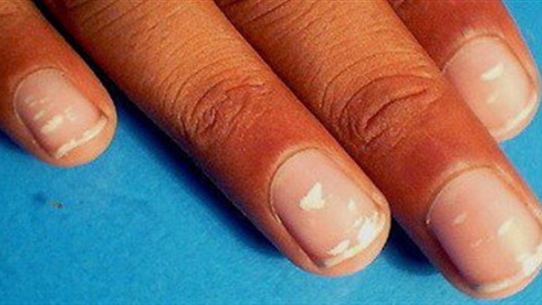 5 أطعمة تعالج هشاشة الأظافر.. تعرفوا عليها