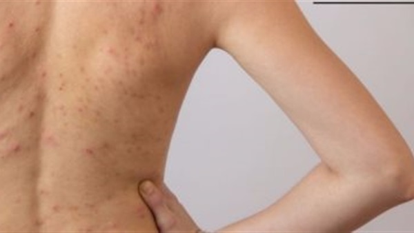 3 علاجات طبيعية للتخلص من حب الشباب بمنطقة الظهر