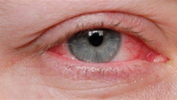 وصفة سحرية لتنظيف العين وإزالة الالتهابات