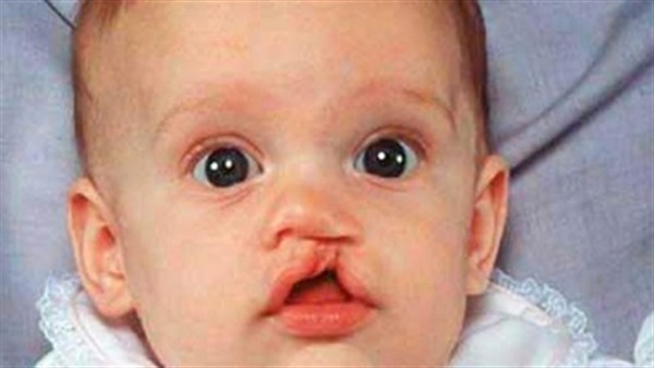 أطباء: 10% زيادة في فرص إصابة الطفل الثاني بتشوه الشفة الأرنبية