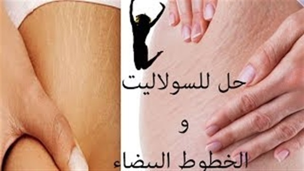 بالفيديو.. طريقة طبيعية للتخلص من السليوليت بالفيديو.. طريقة طبيعية للتخلص من السليوليت