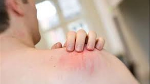 الالتهابات الجلدية الأكثر شيوعا بين الطلاب الممارسين للمصارعة