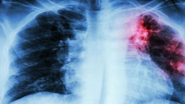أعشاب الطب الصيني القديم تساعد في مكافحة السل أعشاب الطب الصيني القديم تساعد في مكافحة السل
