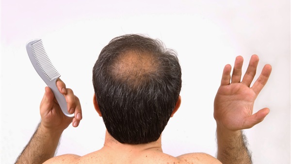 دراسة: تساقط الشعر عند الرجال يرجع لصفات الأم