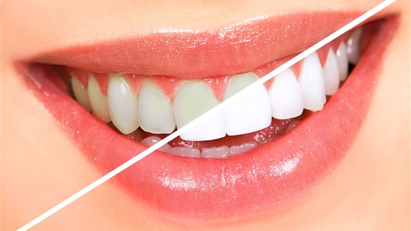 لابتسامة مشرقة.. 5 طرق للحفاظ على عمليات تبييض الأسنان