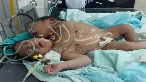 بالصور.. والد الطفلة المولودة برأسين بالمنوفية يطالب بتوفير الرعاية لـ«التوأم» بالصور.. والد الطفلة المولودة برأسين بالمنوفية يطالب بتوفير الرعاية لـ«التوأم»