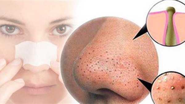 تخلصي من البثور السوداء في 15 دقيقة تخلصي من البثور السوداء في 15 دقيقة