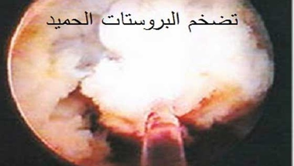 أعراض تضخم البروستاتا الحميد أعراض تضخم البروستاتا الحميد
