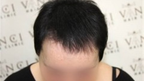 إليك تقنية«SMP » الجديدة لمعالجة مشكلة الصلع