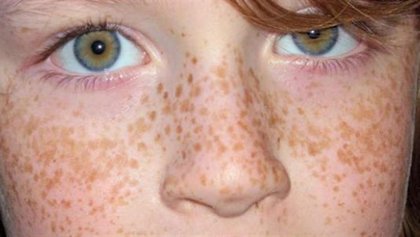 النمش.. سبب ظهوره وكيفية التخلص منه النمش.. سبب ظهوره وكيفية التخلص منه