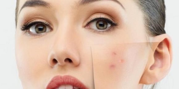 7 نصائح تحميك من حب الشباب (فيديوجراف)