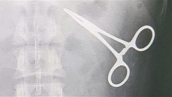 آلة كشف المعادن تعثر على مقص في بطن احد الحجاج  