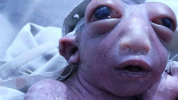 بالصورة.. «طفلة» مولودة بملامح «كائنات فضائية»