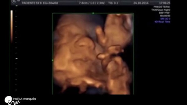 بالفيديو.. جنين يغنى وهو فى بطن أمه  