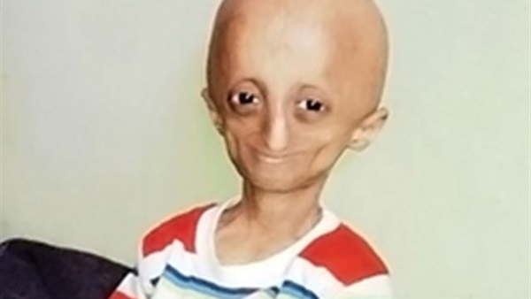 بالصور.. هندى لم يبلغ الـ 14 ومصاب بـ «شيخوخة مبكرة»  