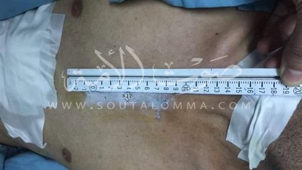 بالصور..  إجراء أول عملية قلب مفتوح بمستشفيات جامعة المنصورة