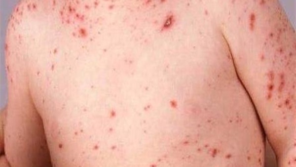 إصابة 23 تلميذ بمرض الجدري فى بنى سويف