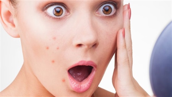 8 وصفات طبيعية لمعالجة حب الشباب