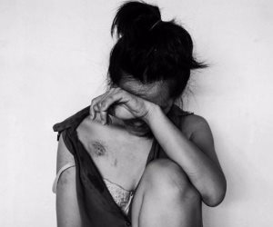 بالصور.. "ذهبت لخلع سنتها فأصيبت باللعنة".. فتاة تفقد وجهها ضحية الإهمال الطبي