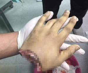 شريعة الغاب تحكم.. قطع يد شاب في الشرابية بعد اتهامه بسرقة «موبايل»