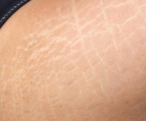 3 طرق علاج منزلية تمكنك من التخلص من علامات تمدد الجلد